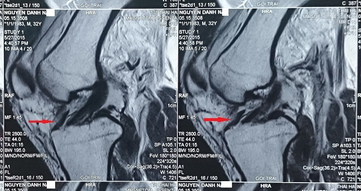 Dấu hiệu 2 dây chằng chéo trước (double ACL): một dấu hiệu hiếm gặp của tổn thương rách sụn chêm quai va li (bucket handle tear of meniscus)