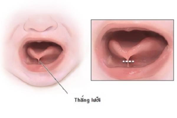 CẮT THẮNG LƯỠI TRẺ EM VÀ NGƯỜI LỚN