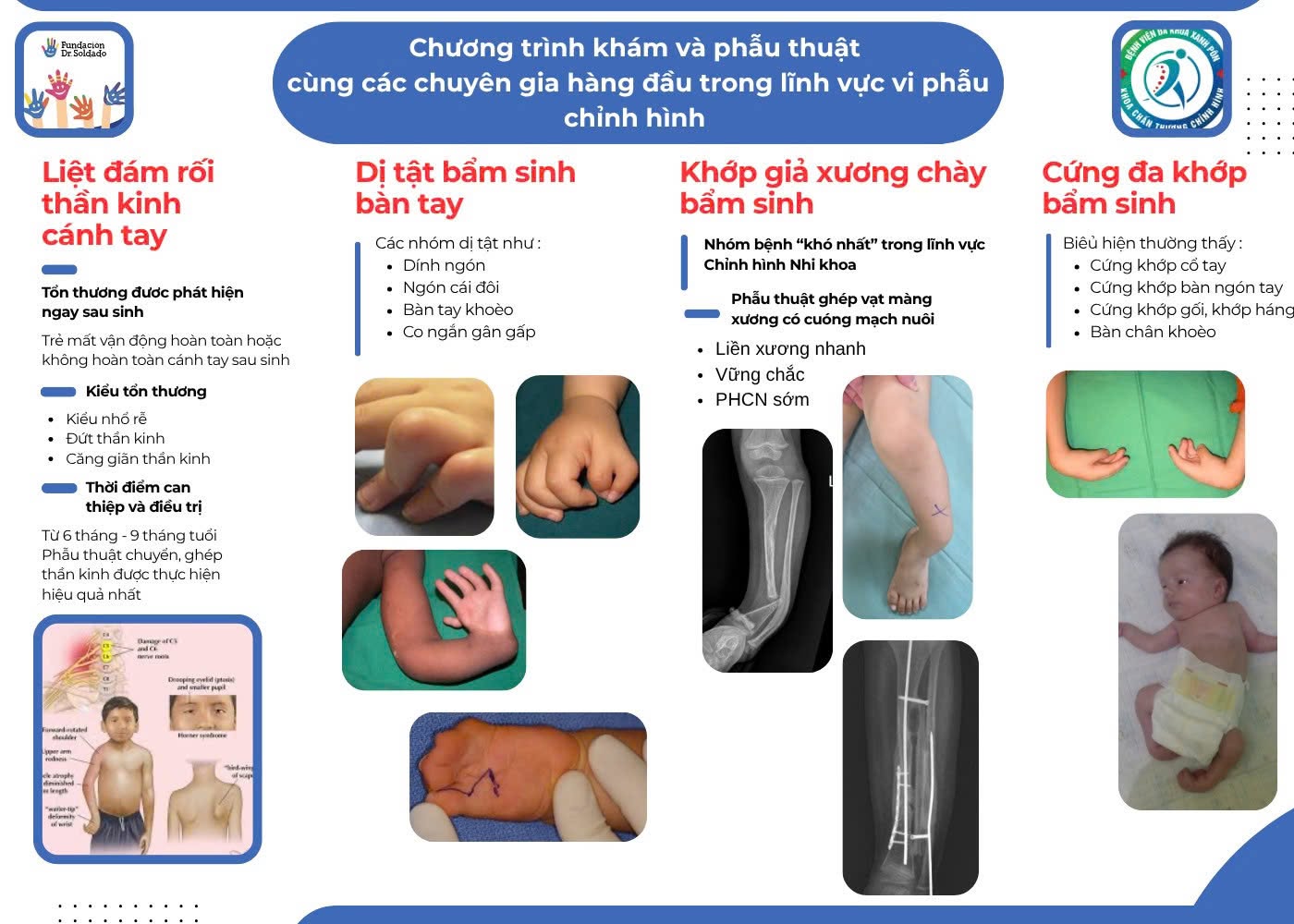 Bệnh viện Đa khoa Xanh Pôn tiếp tục hợp tác quốc tế, mang cơ hội điều trị cho trẻ mắc bệnh lý chỉnh hình phức tạp