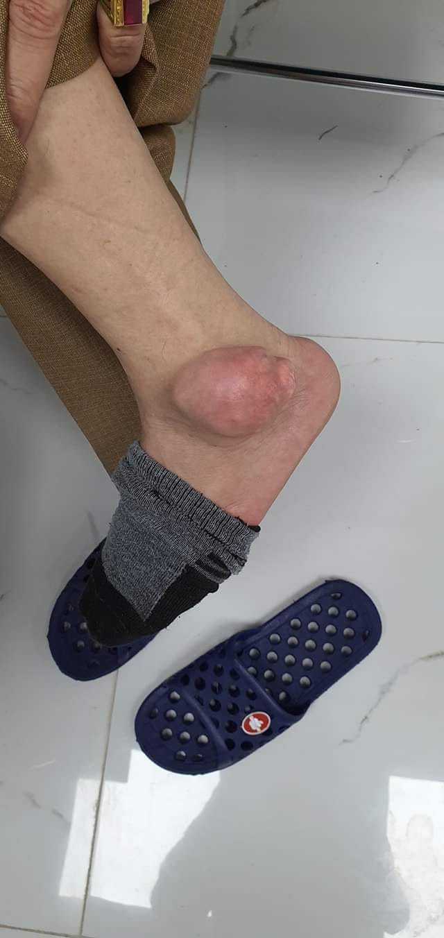 CHỮA BỆNH GOUT BẰNG THUỐC TRÊN MẠNG, BỆNH NHÂN NỔI U TO BẰNG QUẢ ỔI