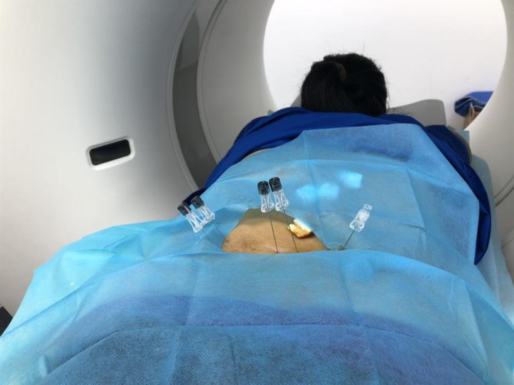 Ứng dụng OZONE trong điều trị Thoát vị đĩa đệm