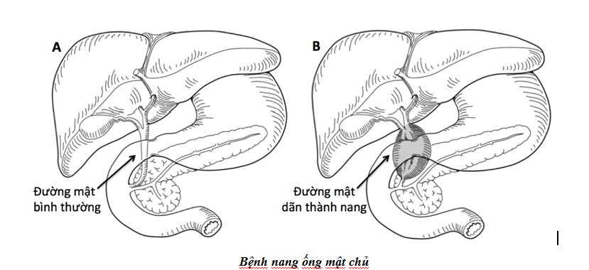 Những điều cần biết về Bệnh Nang ống mật chủ ở trẻ em