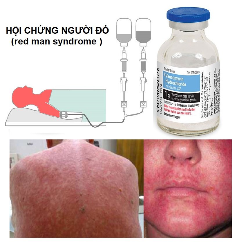 Hội chứng người đỏ liên quan đến cách truyền VANCOMYCIN