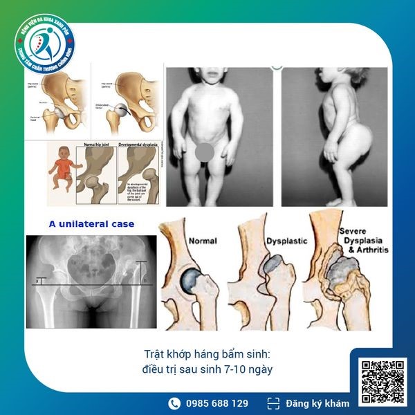 ĐẨY NHANH KHÁM SÀNG LỌC XƯƠNG KHỚP NHI ĐỂ CHUYÊN GIA CHILDREN ACTION HỘI CHẨN & PHẪU THUẬT VÀO THÁNG 6/2023