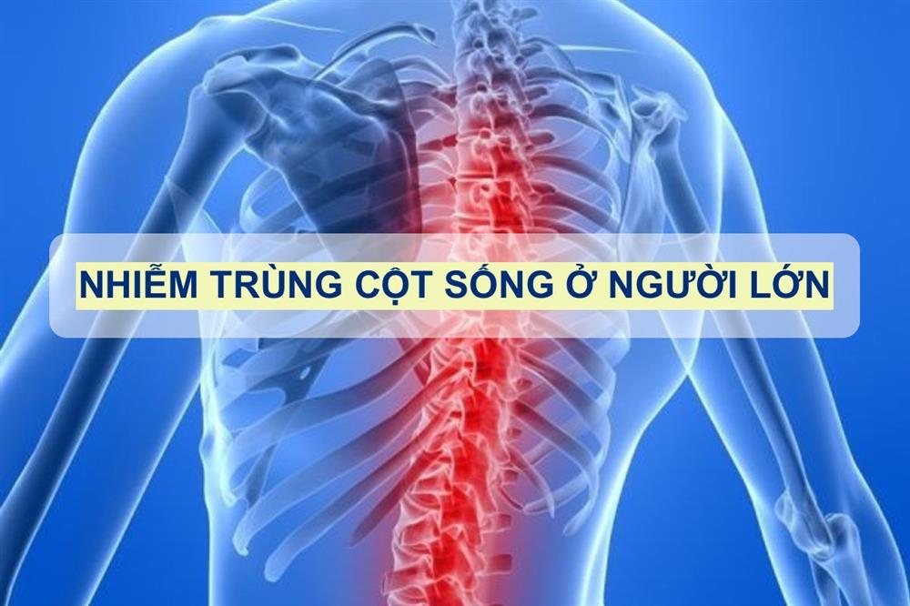 Nhiễm trùng cột sống ở người lớn