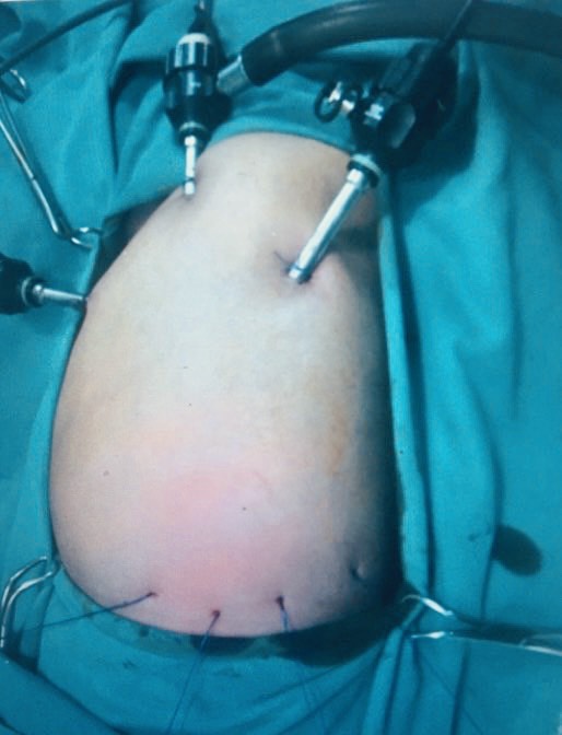 PHẪU THUẬT THÀNH CÔNG CHO HAI CA BỆNH NHI SƠ SINH MẮC THOÁT VỊ HOÀNH TRÁI BẨM SINH