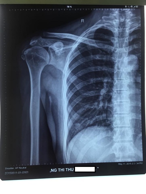 U sụn màng hoạt dịch khoang dưới mỏm cùng vai: 1 tổn thương hiếm gặp
